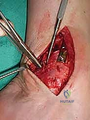 صورة طبية: علاج آفات القبة الكاحلية العظمية الغضروفية بالزرع الذاتي: خبرة الأستاذ الدكتور محمد هطيف في صنعاء