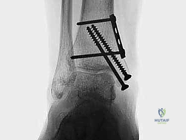 تشريح مفصل الكاحل والقبة الكاحلية