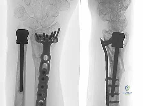 Distal Radioulnar Joint Arthroplasty: A Masterclass in Ulnar Head Implant Technique
