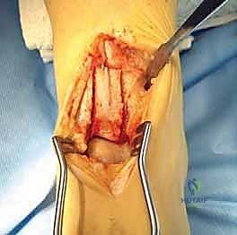 Anterior Tibial Osteotomy: Masterclass in Talus Osteochondral Lesion Repair