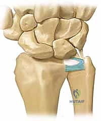 Illustration of fibrocartilage complex dbridement - Dr. Mohammed Hutaif