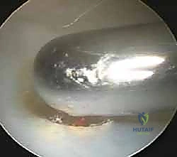 علاج تمزق الغضروف المثلثي ومتلازمة انحشار الزند بالمنظار: دليلك الشامل في صنعاء