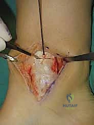 فحص نطاق حركة الكاحل