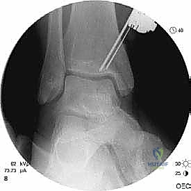 صورة رنين مغناطيسي دقيقة للآفة