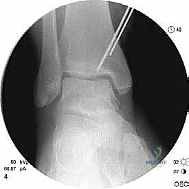 صورة أشعة سينية للكاحل