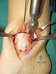 التواء الكاحل الشديد