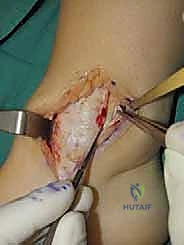 Illustration of medial malleolar osteotomy - Dr. Mohammed Hutaif