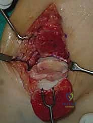 صورة طبية: إعادة بناء آفة الكاحل الغضروفية العظمية الكبيرة بالطعم الخيفي الهيكلي: دليل شامل للمرضى مع الأستاذ الدكتور محمد هطيف