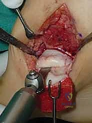 صورة رنين مغناطيسي توضح تكيسات الكاحل