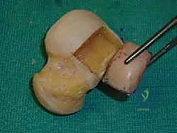 إعادة بناء آفة الكاحل الغضروفية العظمية الكبيرة بالطعم الخيفي الهيكلي: دليل شامل للمرضى مع الأستاذ الدكتور محمد هطيف