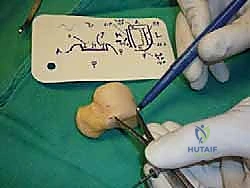 مقارنة الإجراءات الجراحية