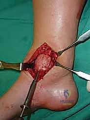 صورة توضيحية لـ إعادة بناء آفة الكاحل الغضروفية العظمية الكبيرة بالطعم الخيفي الهيكلي: دليل شامل للمرضى مع الأستاذ الدكتور محمد هطيف