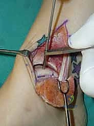 صورة توضيحية لـ إعادة بناء آفة الكاحل الغضروفية العظمية الكبيرة بالطعم الخيفي الهيكلي: دليل شامل للمرضى مع الأستاذ الدكتور محمد هطيف