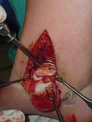 صورة توضيحية لـ إعادة بناء آفة الكاحل الغضروفية العظمية الكبيرة بالطعم الخيفي الهيكلي: دليل شامل للمرضى مع الأستاذ الدكتور محمد هطيف