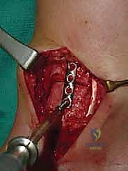 صورة توضيحية لـ إعادة بناء آفة الكاحل الغضروفية العظمية الكبيرة بالطعم الخيفي الهيكلي: دليل شامل للمرضى مع الأستاذ الدكتور محمد هطيف