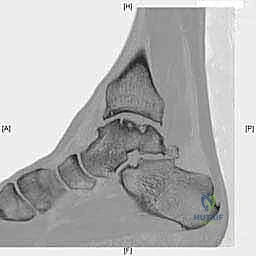 صورة طبية: إعادة بناء آفة الكاحل الغضروفية العظمية الكبيرة بالطعم الخيفي الهيكلي: دليل شامل للمرضى مع الأستاذ الدكتور محمد هطيف