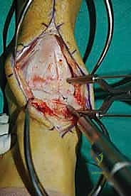 صورة طبية: إعادة بناء آفة الكاحل الغضروفية العظمية الكبيرة بالطعم الخيفي الهيكلي: دليل شامل للمرضى مع الأستاذ الدكتور محمد هطيف