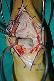 صورة طبية: إعادة بناء آفة الكاحل الغضروفية العظمية الكبيرة بالطعم الخيفي الهيكلي: دليل شامل للمرضى مع الأستاذ الدكتور محمد هطيف