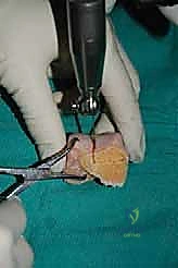 صورة طبية: إعادة بناء آفة الكاحل الغضروفية العظمية الكبيرة بالطعم الخيفي الهيكلي: دليل شامل للمرضى مع الأستاذ الدكتور محمد هطيف