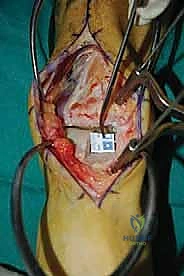 صورة طبية: إعادة بناء آفة الكاحل الغضروفية العظمية الكبيرة بالطعم الخيفي الهيكلي: دليل شامل للمرضى مع الأستاذ الدكتور محمد هطيف