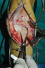 صورة طبية: إعادة بناء آفة الكاحل الغضروفية العظمية الكبيرة بالطعم الخيفي الهيكلي: دليل شامل للمرضى مع الأستاذ الدكتور محمد هطيف
