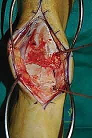 صورة طبية: إعادة بناء آفة الكاحل الغضروفية العظمية الكبيرة بالطعم الخيفي الهيكلي: دليل شامل للمرضى مع الأستاذ الدكتور محمد هطيف