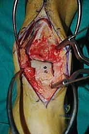 صورة طبية: إعادة بناء آفة الكاحل الغضروفية العظمية الكبيرة بالطعم الخيفي الهيكلي: دليل شامل للمرضى مع الأستاذ الدكتور محمد هطيف