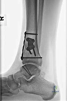صورة طبية: إعادة بناء آفة الكاحل الغضروفية العظمية الكبيرة بالطعم الخيفي الهيكلي: دليل شامل للمرضى مع الأستاذ الدكتور محمد هطيف