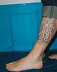 صورة طبية: إعادة بناء آفة الكاحل الغضروفية العظمية الكبيرة بالطعم الخيفي الهيكلي: دليل شامل للمرضى مع الأستاذ الدكتور محمد هطيف