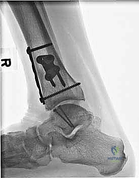 صورة طبية: إعادة بناء آفة الكاحل الغضروفية العظمية الكبيرة بالطعم الخيفي الهيكلي: دليل شامل للمرضى مع الأستاذ الدكتور محمد هطيف