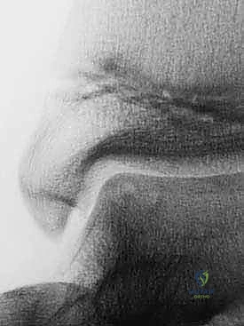 صورة توضيحية لأسباب إصابات غضروف الكاحل