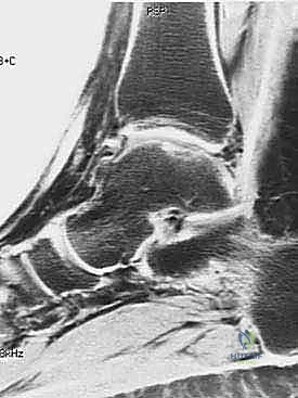 صورة توضيحية لـ زراعة الغضاريف الذاتية للكاحل: حل متطور لآفات الغضروف العظمي واستعادة الحركة