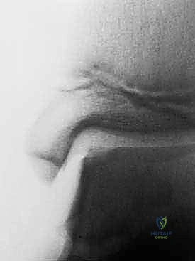 صورة توضيحية لتشريح مفصل الكاحل وآفات الغضروف العظمي