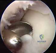 المرحلة الأولى: حصاد الخلايا الغضروفية