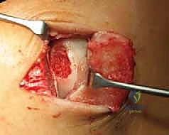 المرحلة الثانية: زراعة الخلايا في الكاحل
