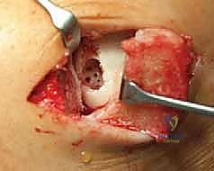 صورة توضيحية لـ زراعة الغضاريف الذاتية للكاحل: حل متطور لآفات الغضروف العظمي واستعادة الحركة