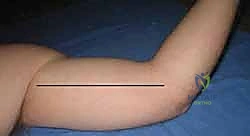 علامات وأعراض متلازمة الحيز