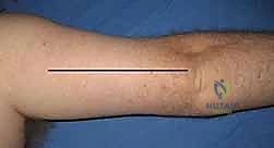 جهاز قياس ضغط الحيز العضلي