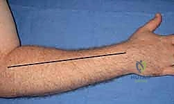 الشق الجراحي الأمامي للساعد