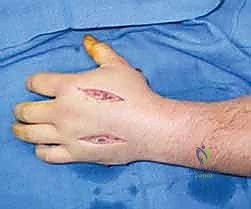 صورة توضيحية لـ متلازمة الحيز الحادة في الطرف العلوي: سباق مع الزمن لإنقاذ وظيفة يدك وذراعك مع الأستاذ الدكتور محمد هطيف في صنعاء