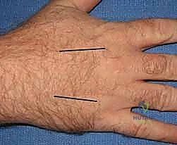 بضع اللفافة في اليد