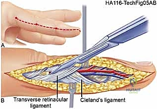 صورة توضيحية لـ متلازمة الحيز الحادة في الطرف العلوي: سباق مع الزمن لإنقاذ وظيفة يدك وذراعك مع الأستاذ الدكتور محمد هطيف في صنعاء