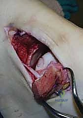 استئصال الكعب الإنسي على شكل شيفرون: دليل شامل لعلاج إصابات قبة الكاحل المعقدة مع الأستاذ الدكتور محمد هطيف