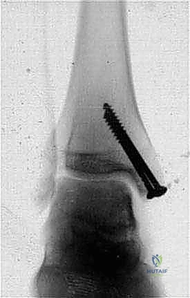 صورة توضيحية لـ استئصال الكعب الإنسي على شكل شيفرون: دليل شامل لعلاج إصابات قبة الكاحل المعقدة مع الأستاذ الدكتور محمد هطيف