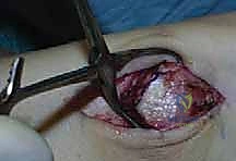 صورة توضيحية لـ استئصال الكعب الإنسي على شكل شيفرون: دليل شامل لعلاج إصابات قبة الكاحل المعقدة مع الأستاذ الدكتور محمد هطيف