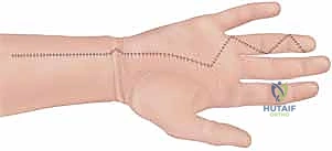 استئصال الأنسجة الميتة بدقة