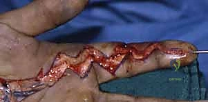 استخدام تقنيات الجراحة المجهرية