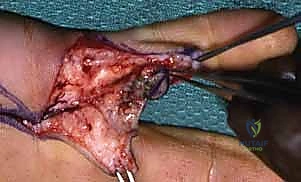 تقييم حيوية الأنسجة قبل إنهاء الجراحة