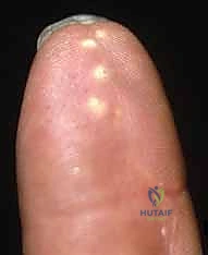 إصابات الحقن بالضغط العالي في اليد دليل شامل من الأستاذ الدكتور محمد هطيف