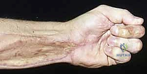 استكشاف الأنسجة العميقة في اليد